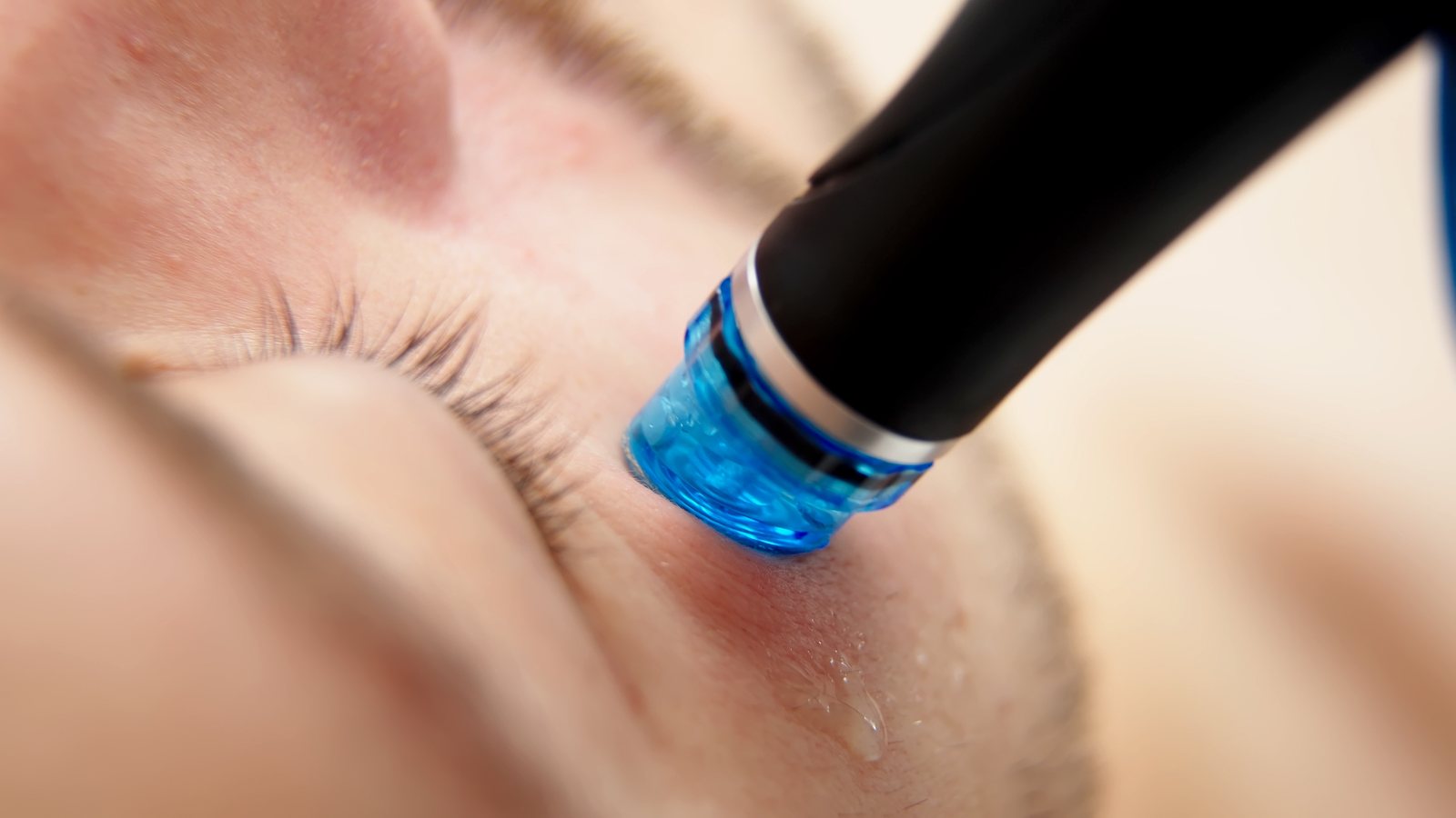 Aquafacial-Behandlung mit technischer Wirkstoffversorgung